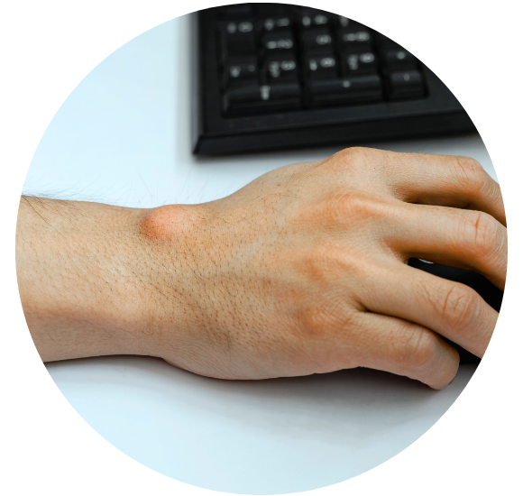 Hand Ganglion Überbein Hanau, Offenbach, Seligenstadt